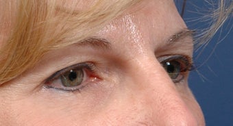 Endoscopic Browlift and Upper lid Blepharoplasty before 414272