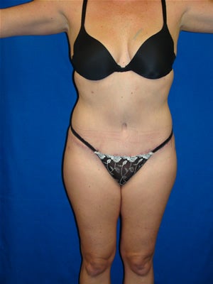 Tummy Tuck Surgery (Abdominoplasty) after 151559