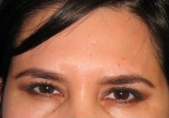 Botox after 371665