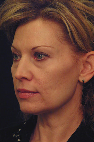Yag Laser Skin Tightening before 347568