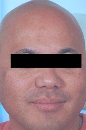 Asian Skin Freckle Removal after 199403