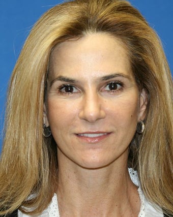 Short Incision Face Lift and periorbital fat transfer after 223301
