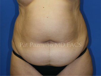 Tummy tuck before 199309
