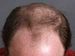 Hair Transplant before 426673