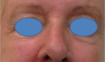 Juvederm Filler for lower eyelid hollows before 77458