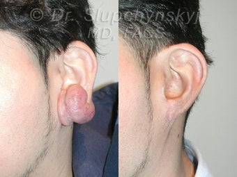 Keloid Removal before 551920