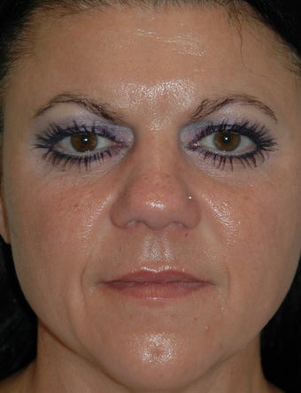 Microdermabrasion and Obagi Skin Care Products after 548916