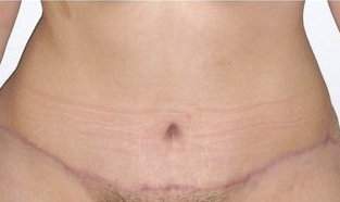 Tummy Tuck (Abdominoplasty) after 142536