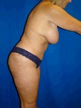 Mommy Makeover 409478