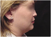 chin lipo with platysmal plication (mini necklift) before 267585