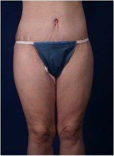 Lower Body Lift after Massive Weight Loss (Gastric Bypass) after 224112