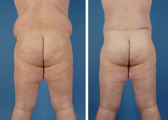 Upper & Lower Body Lift 335976