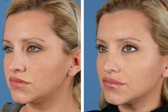 Botox Cosmetic & Restylane 356613