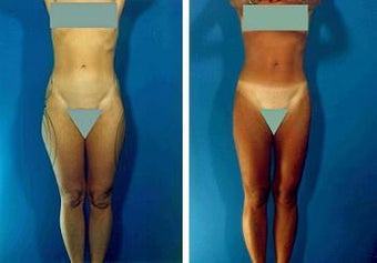 Liposuction before 636223
