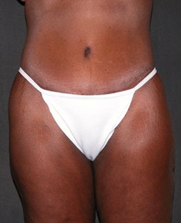 Tummy Tuck with Flank Liposuction after 330898