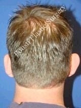 Ear Surgery (Otoplasty) before 616622