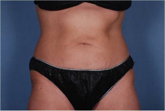 Liposonix to Abdomen after 448753