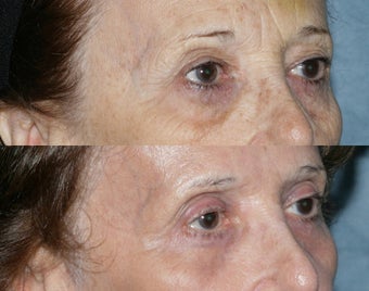 Fraxel Repair in Combination with other lasers yields best results before 149676