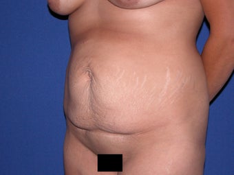 Abdominoplasty with liposuction of flanks before 300378