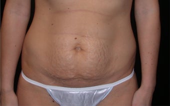 Tummy tuck before 197303