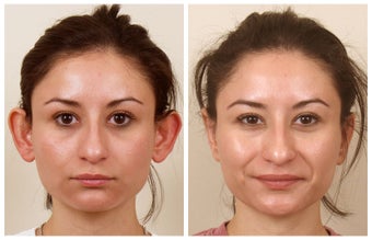 Otoplasty before 325135
