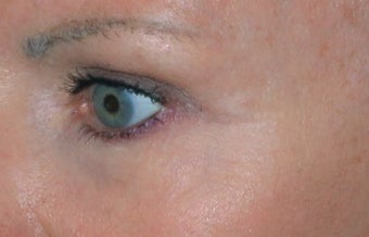 Facial vein removal after 374364