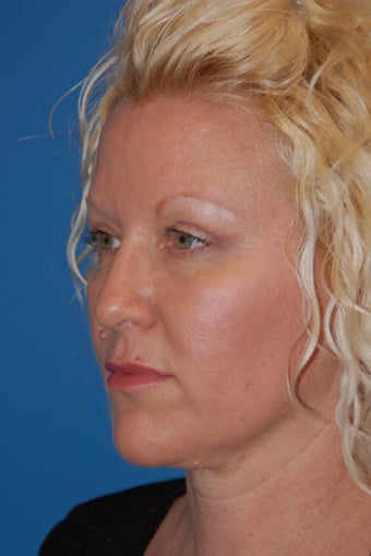 Blepharoplasty or "eyelid lift" after 502053