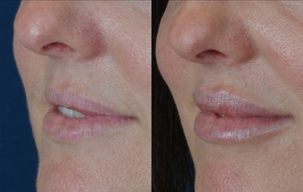 Lip Augmentation after 511369
