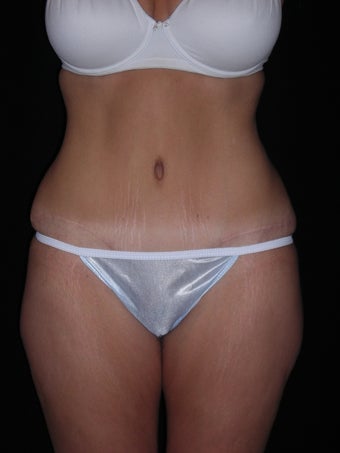 Tummy tuck after 275256