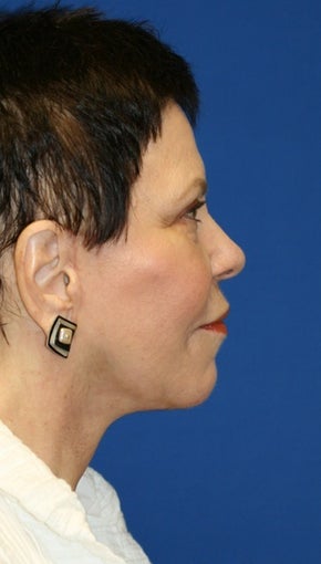 Facelift with Extended Necklift, Browlift, Fat Transfer, Upper Blepharoplasty, and Skin Pinch 625450