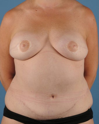 Breast Reconstruction after 509615