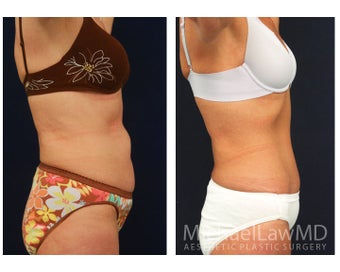 Abdominoplasty - Tummy Tuck 396080