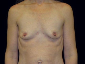 Breast augmentation before 293936