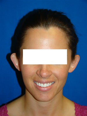Otoplasty (Ear Surgery) before 152800