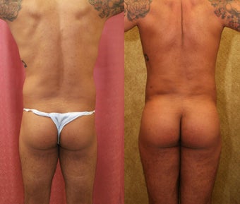 Brazilian buttock augmentation with fat grafting to the buttocks with liposuction in Los Angeles after 583433