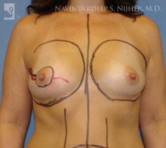 Breast Reconstruction before 502529