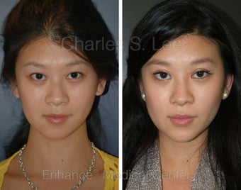 Blepharoplasty, Rhinoplasty and Chin Augmentation before 426942