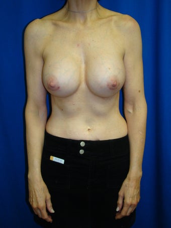 Breast Augmentation Revision after 75891
