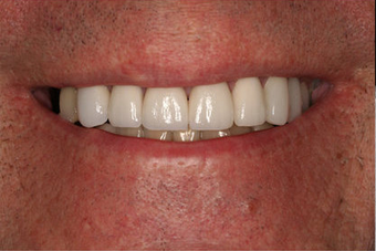Full Porcelain Crowns after 145681