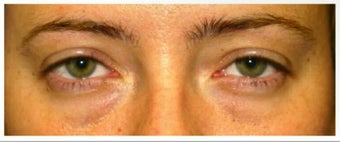 Lower Eyelid Surgery before 526491