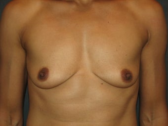 Bilateral Breast Augmentation with Silicone Gel Implants before 472900