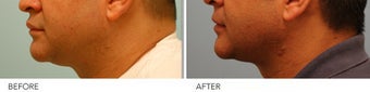 Male Upper Lip Reduction 309222
