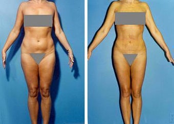 Liposuction before 636214