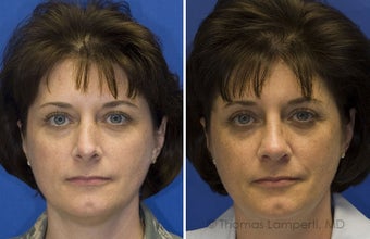 Revision Rhinoplasty before 236699