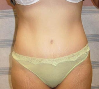 Tummy Tuck after 137947