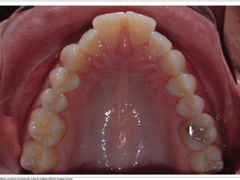 Invisalign 362339