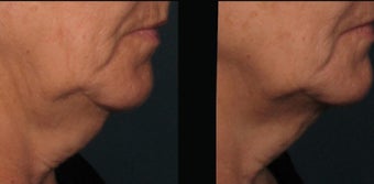 Ultherapy before 460627