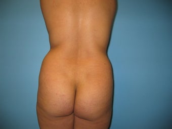 Buttock augmentation (Brazilian buttock lift) before 287962