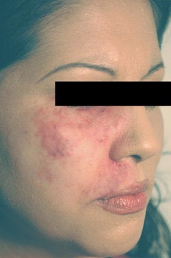 Port Wine Birthmark Removal with Pulsed Dye Lasers after 104204