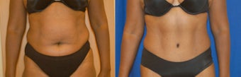 Tummy tuck before 143287